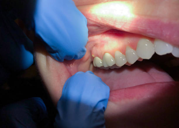 Best Emergency Treatment for Dental Infections or Abscesses in Rio Vista, TX